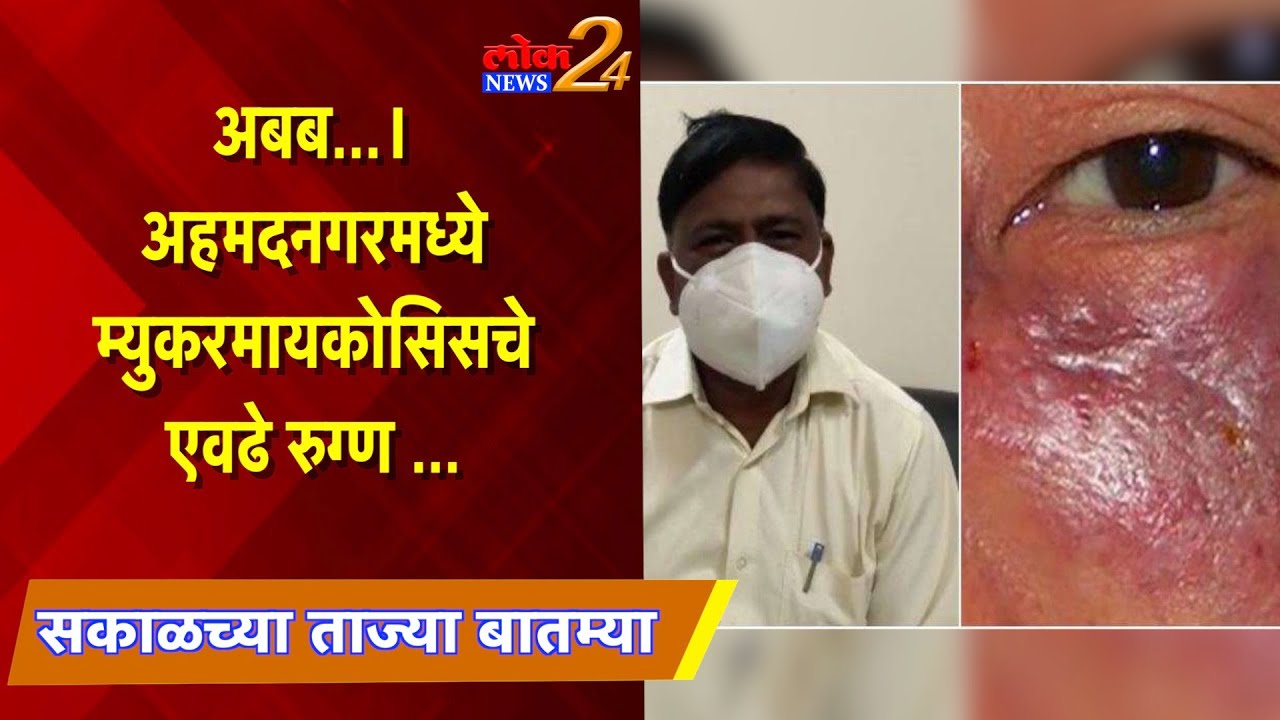 अबब ; अहमदनगर मध्ये म्युकरमायकोसिसचे एवढे रुग्ण! पहा LokNews24*
